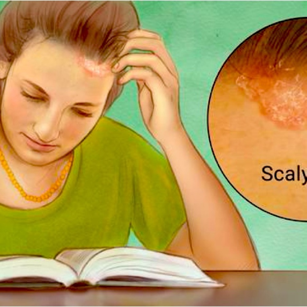Body Foam against Psoriasis